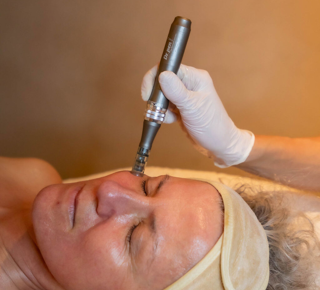microneedling miami
