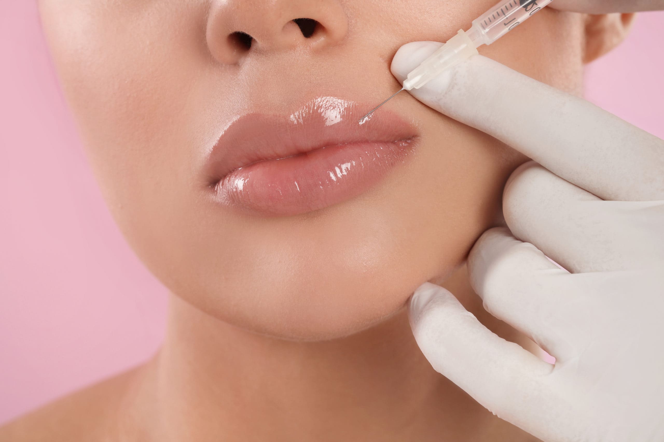 Lip filler injection treatment at Zeugma Spa Miami Edgewater