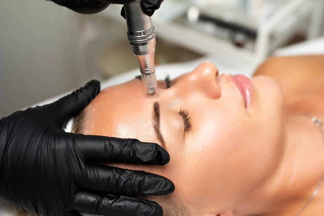 Professional microneedling session at Zeugma Spa Miami